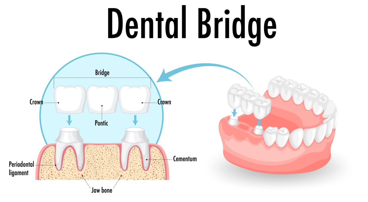 Dental Bridges in Batesville & Salem